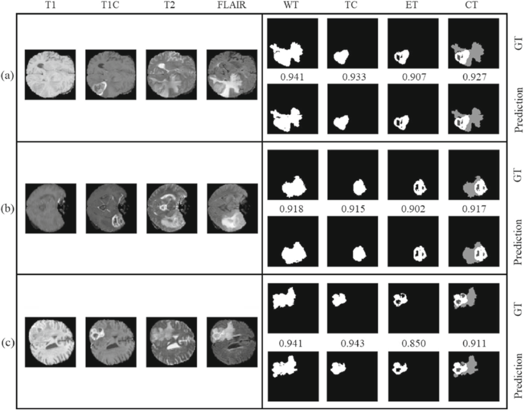 BraTS segmentation results using dice similarity score.