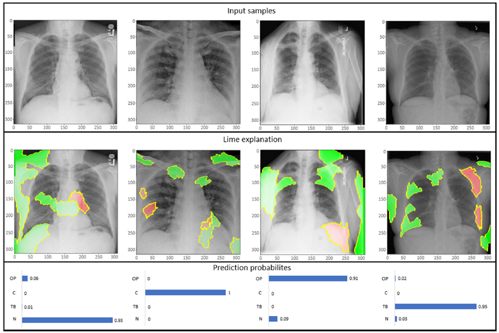 LIME explanation of three distinct class samples using NASNetLarge along with the prediction probabilities of sample being normal (N), COVID-19 (C), and other pneumonia (OP).